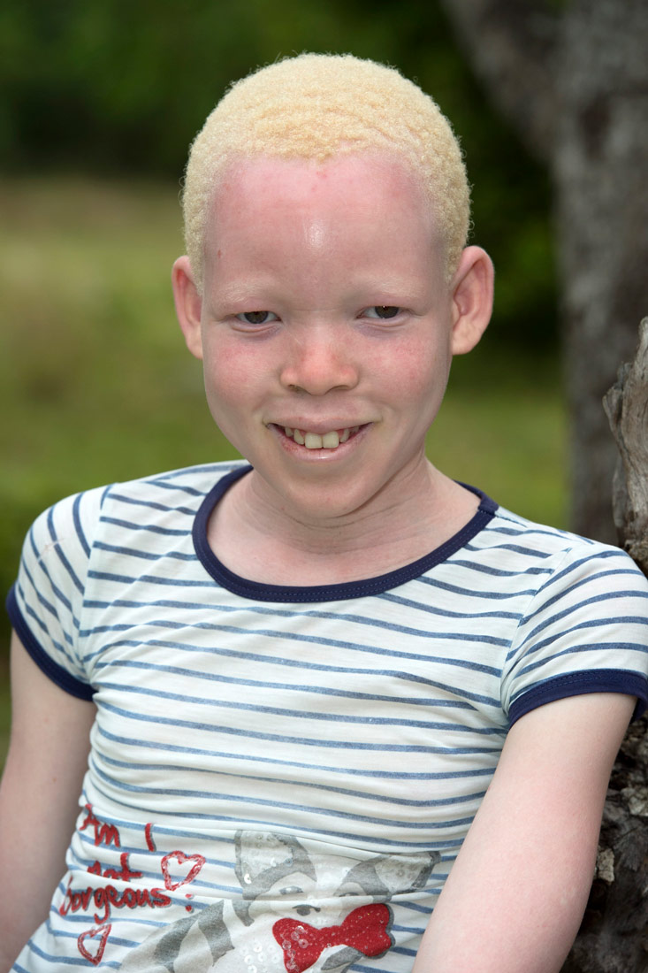Albino djevojčica