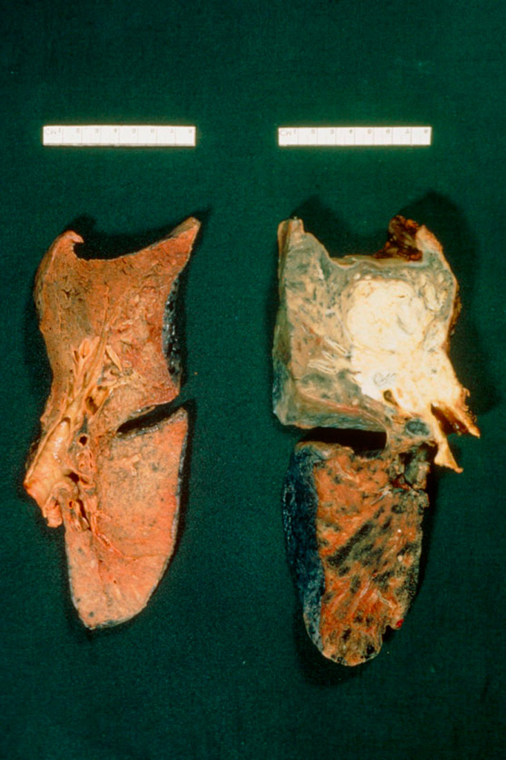 Prikazana je fotografija pluća zdrave osobe pored kojih su pluća osobe koja je imala rak. Pluća zdrave osobe su jednobojna, rozo-narančaste nijanse. Pluća oboljela od raka su promijenjene boje, bijela i naotečena u gornjem dijelu te smežurana i plavičasta u donjem dijelu.