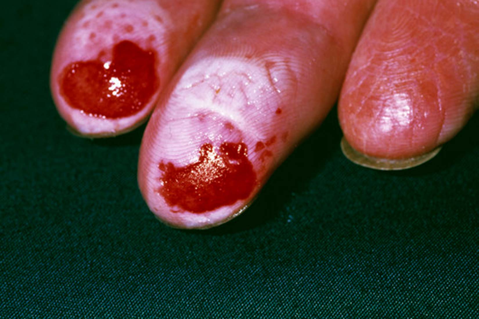 Opekline prouzročene djelovanjem natrijeva hidroksida