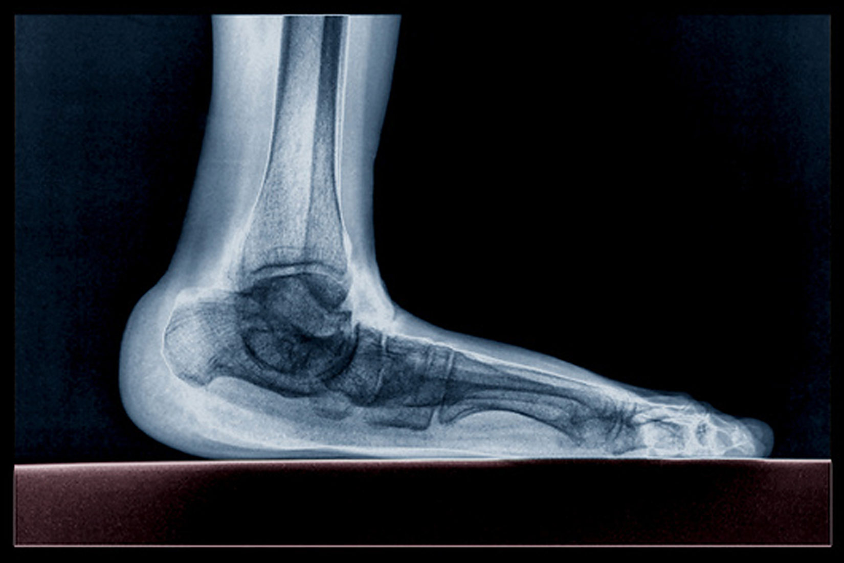 Slika 10. Rendgenska slika spuštenog stopala