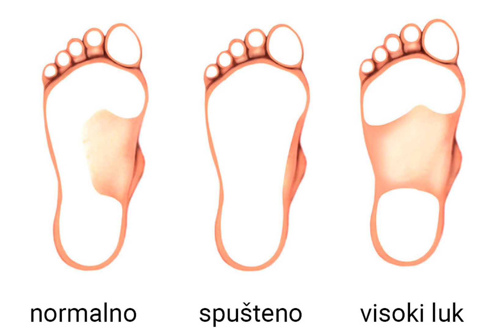 Slika 1. Slika pokazuje tri tipa stopala prikazanog odozdo. Normalno, spušteno i visoki luk.