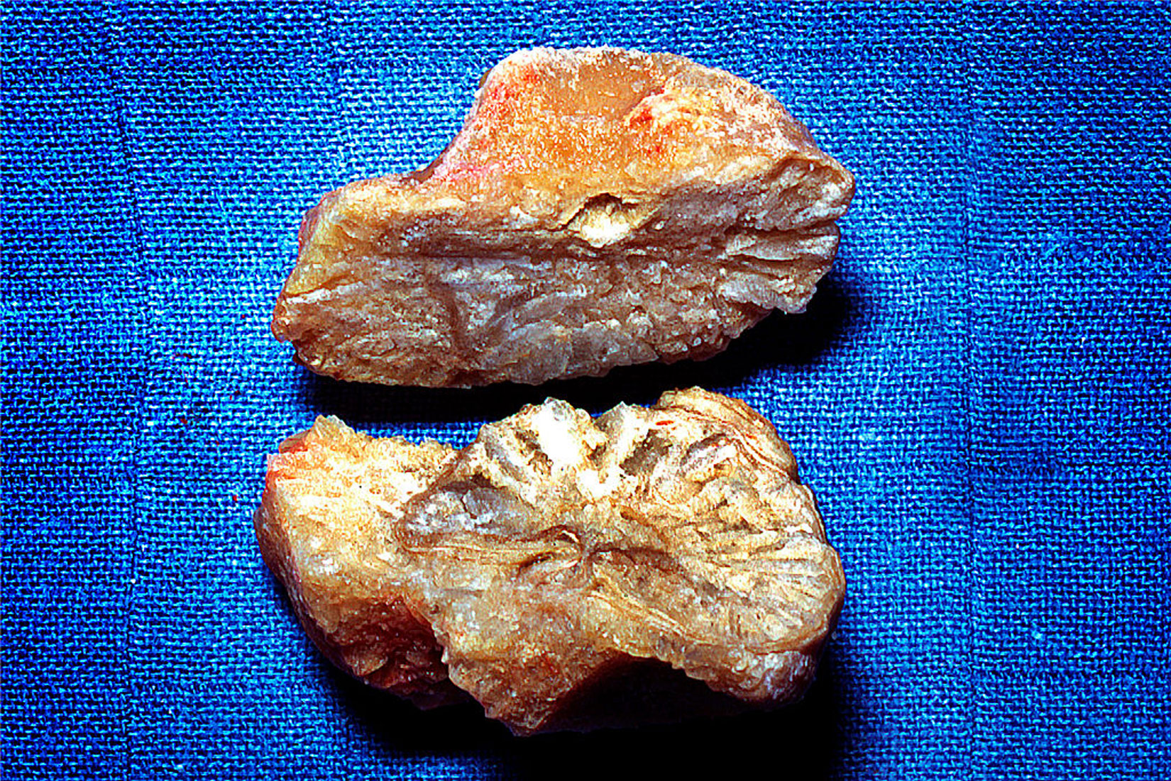 Slika 2. Kristali mokraćne kiseline, bubrežni kamenci