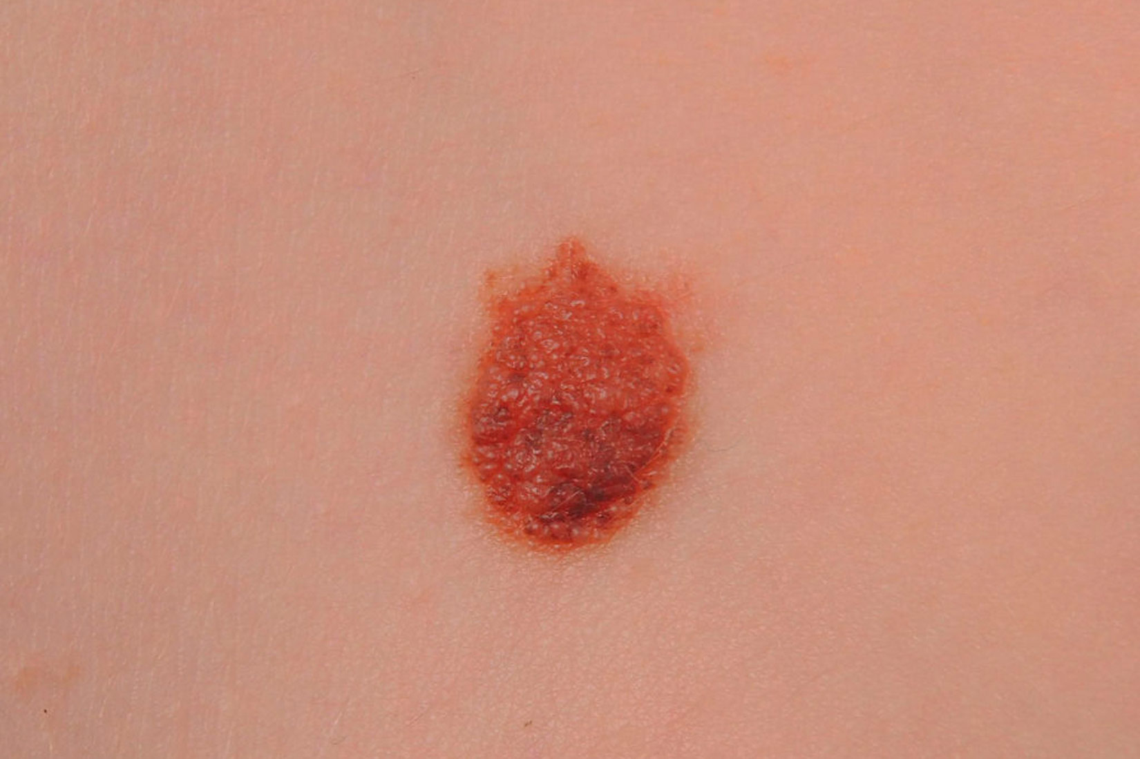 Slika 5. Prikazana je fotografija madeža nepravilnog ruba, promijenjene boje