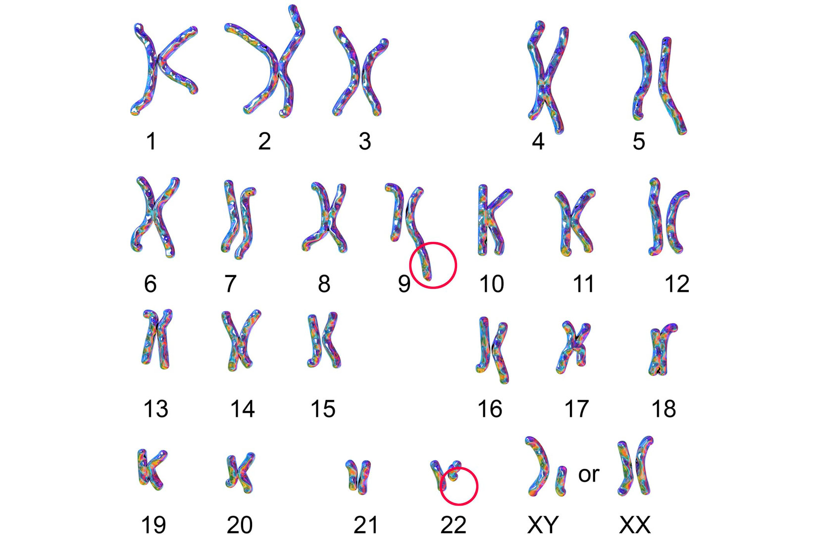 Slika 3. Slika prikazuje ljudski kariogram s nedostatkom dijela kromosoma 22. To je uzrok nastanka mutacija.