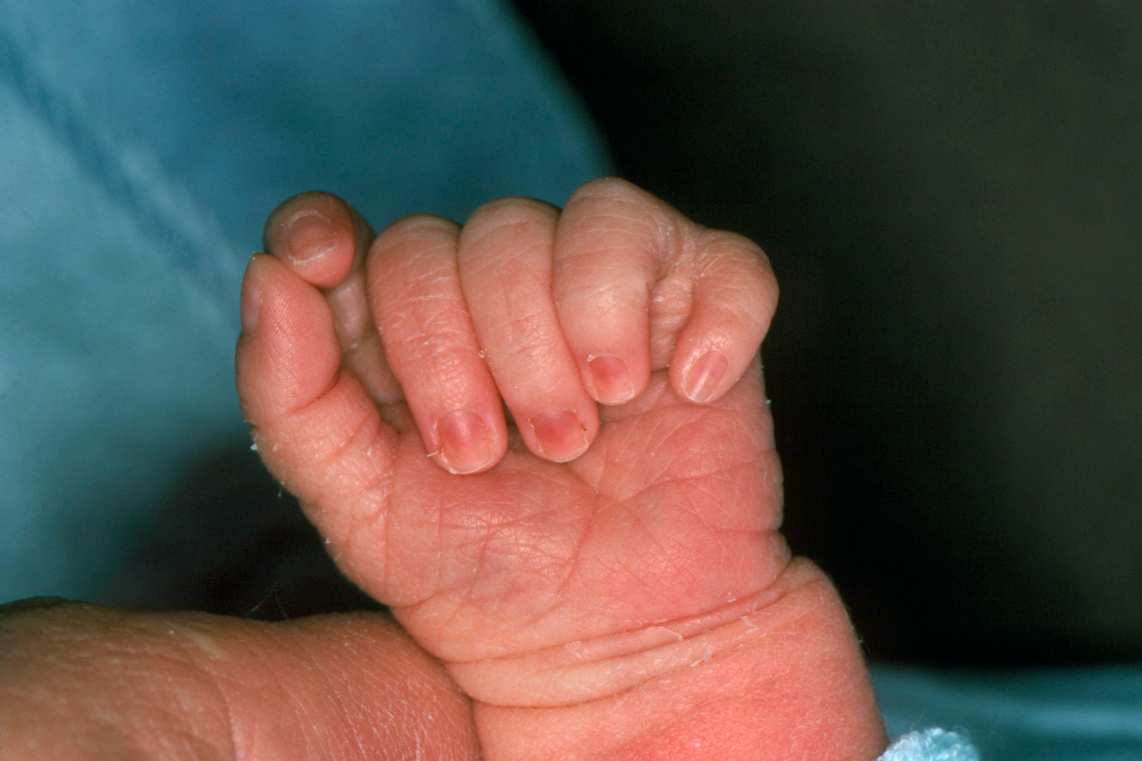 Fotografija prikazuje ruku bebe sa šest prstiju