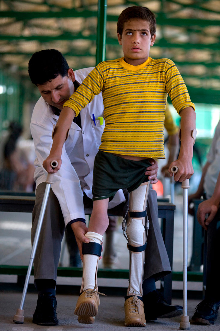 Na fotografiji je prikazan dječak na štakama koji ima ortoze na nogama. Mišići nogu su mu atrofirani i jako slabi. Iza njega stoji doktor koji mu namješta ortoze.