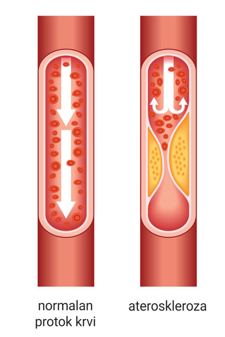 Slika prikazuje dvije krvne žile i njihovu unutrašnjost. U desnoj krv normalno teče, a lijevoj je stijenka krvne žile obložena žutom masa koja spriječava protok krvi. Ispod te žile piše ateroskleroza.