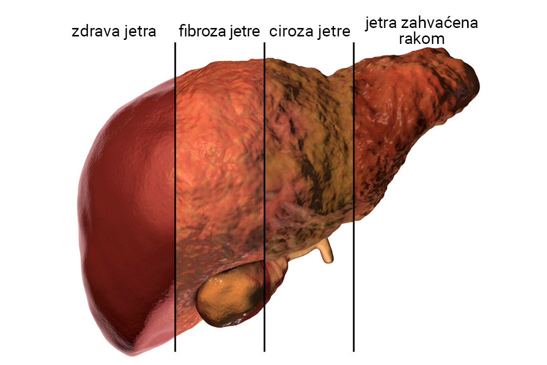 Fotografija prikazuje ljudsku jetru. Jetra je uzdužnim crtama podijeljena na 4 dijela. Prvi dio prikazuje zdravu jetru. Ona je sjajna, glatke površine, crvenkaste boje. Na drugom je dijelu jetra oboljela od fibroze. Površina je hrapava, a crvenkasta boja je izblijedjela. Treći dio prikazuje jetru oboljelu od ciroze, žuto-zelene boje. Površina je vrlo hrapava i nepravilna, vide se mnogobrona udubljenja i ispupčenja. Četvrti dio prikazuje jetru oboljelu od raka. I na njoj vidimo hrapavu površinu punu udubljenja i ispupčenja.